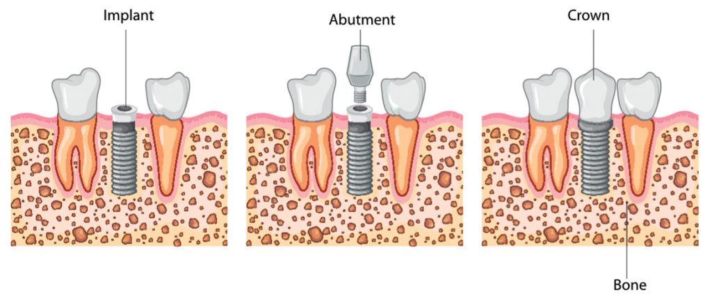 Dental Implantation Process