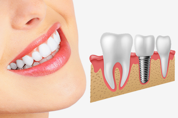 Dental Implant