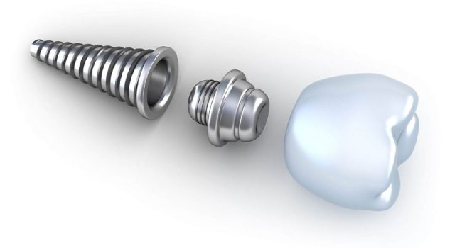 Dental Implants in Antalya Dental Implants in Antalya